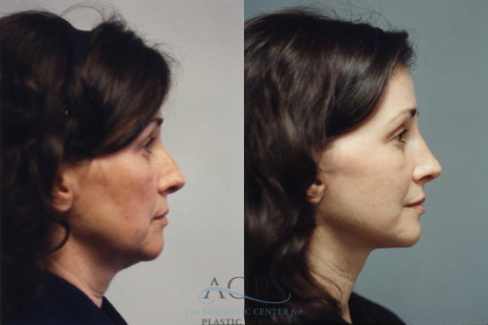 Before & After Facelift Case 1250 Side View: View in Houston, TX