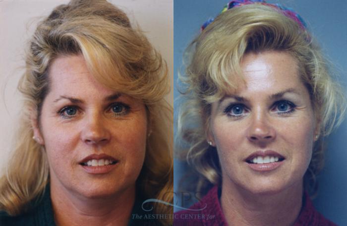 Before & After Facelift Case 1251 Front View: View in Houston, TX