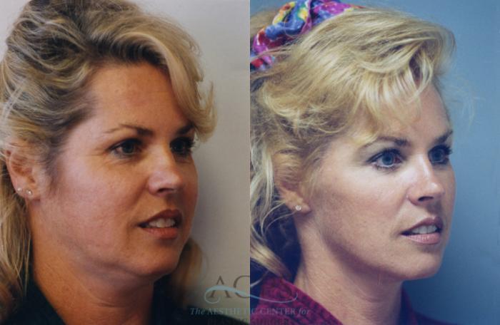 Before & After Facelift Case 1251 Oblique View: View in Houston, TX