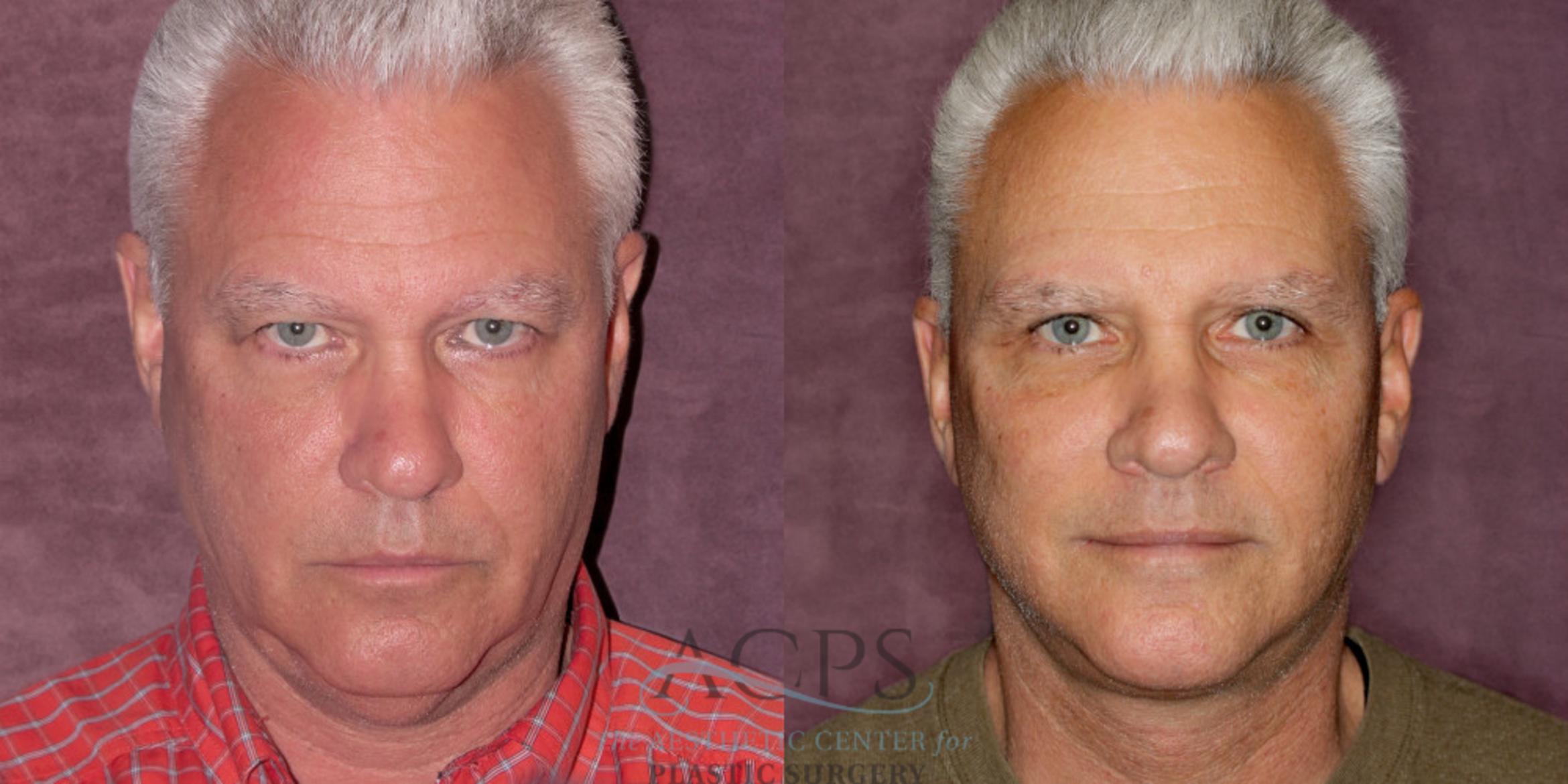 Before & After Facelift Case 1252 Front View: View in Houston, TX