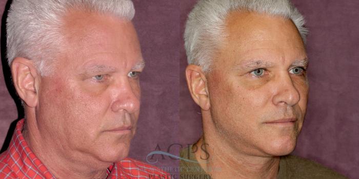 Before & After Facelift Case 1252 Oblique Right View: View in Houston, TX