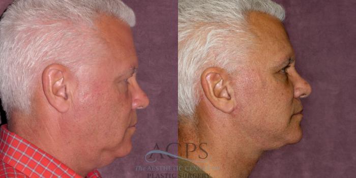 Before & After Facelift Case 1252 Side Left View: View in Houston, TX