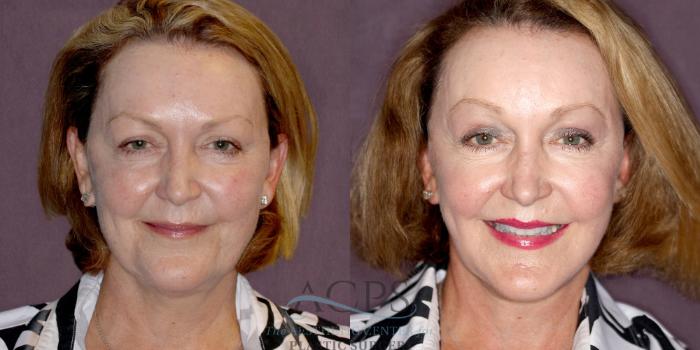 Before & After Facelift Case 1253 Front View: View in Houston, TX