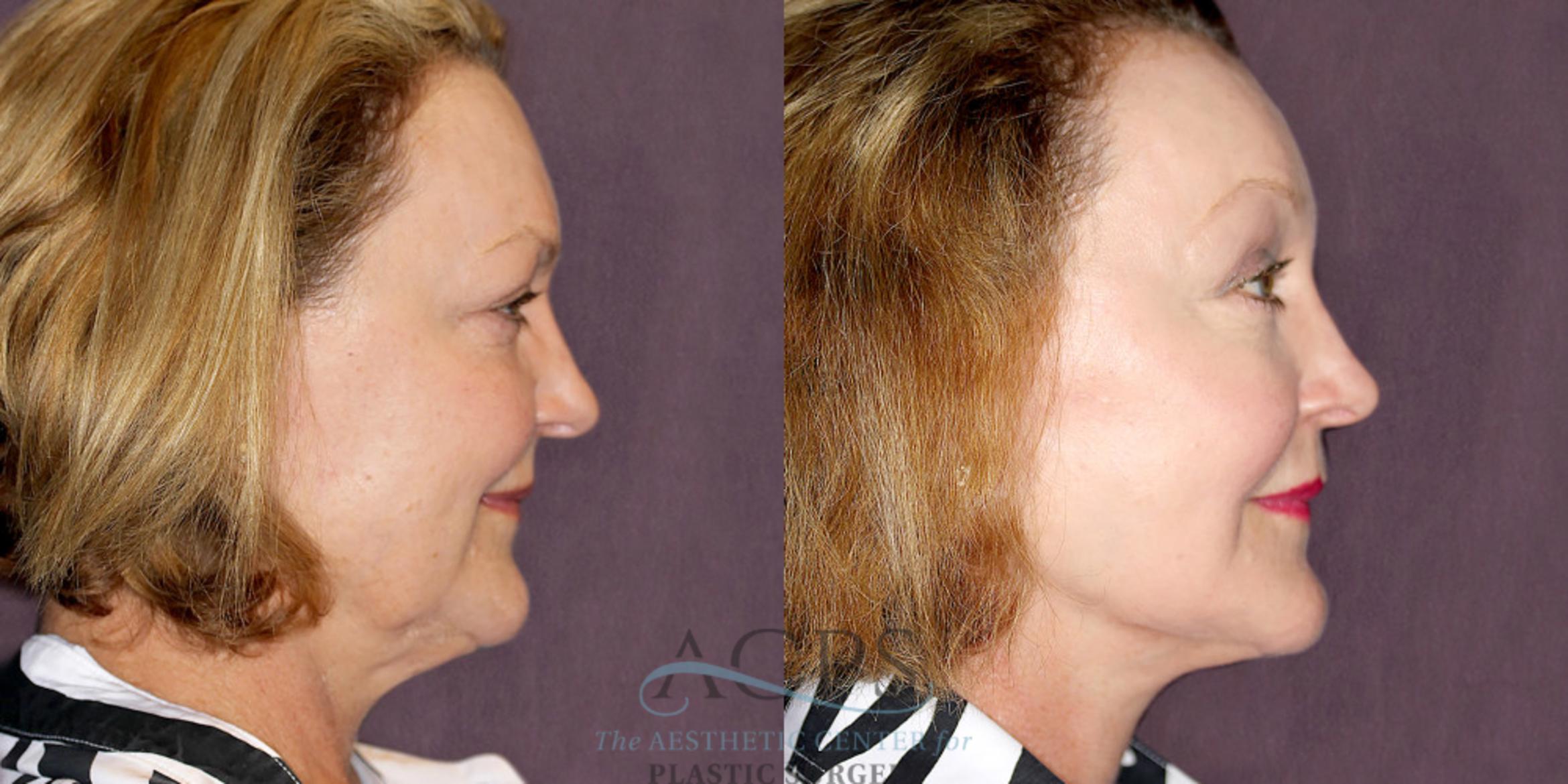 Before & After Facelift Case 1253 Oblique Right View: View in Houston, TX