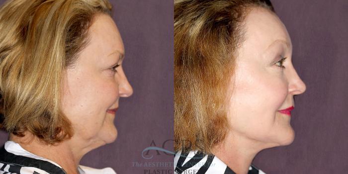Before & After Facelift Case 1253 Oblique Right View: View in Houston, TX