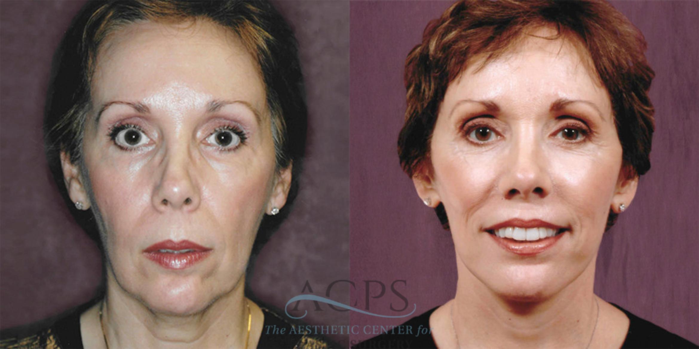 Before & After Facelift Case 1254 Front View: View in Houston, TX