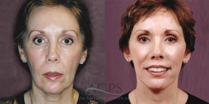 Before & After Facelift Case 1254 Front View: View in Houston, TX