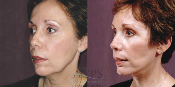 Before & After Facelift Case 1254 Oblique Left View: View in Houston, TX