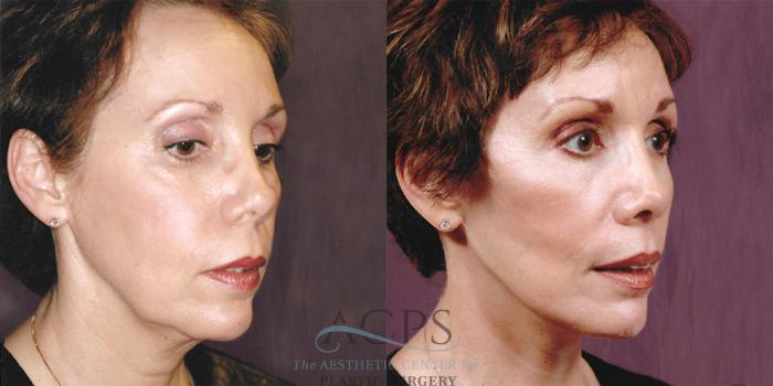 Before & After Facelift Case 1254 Oblique Right View: View in Houston, TX
