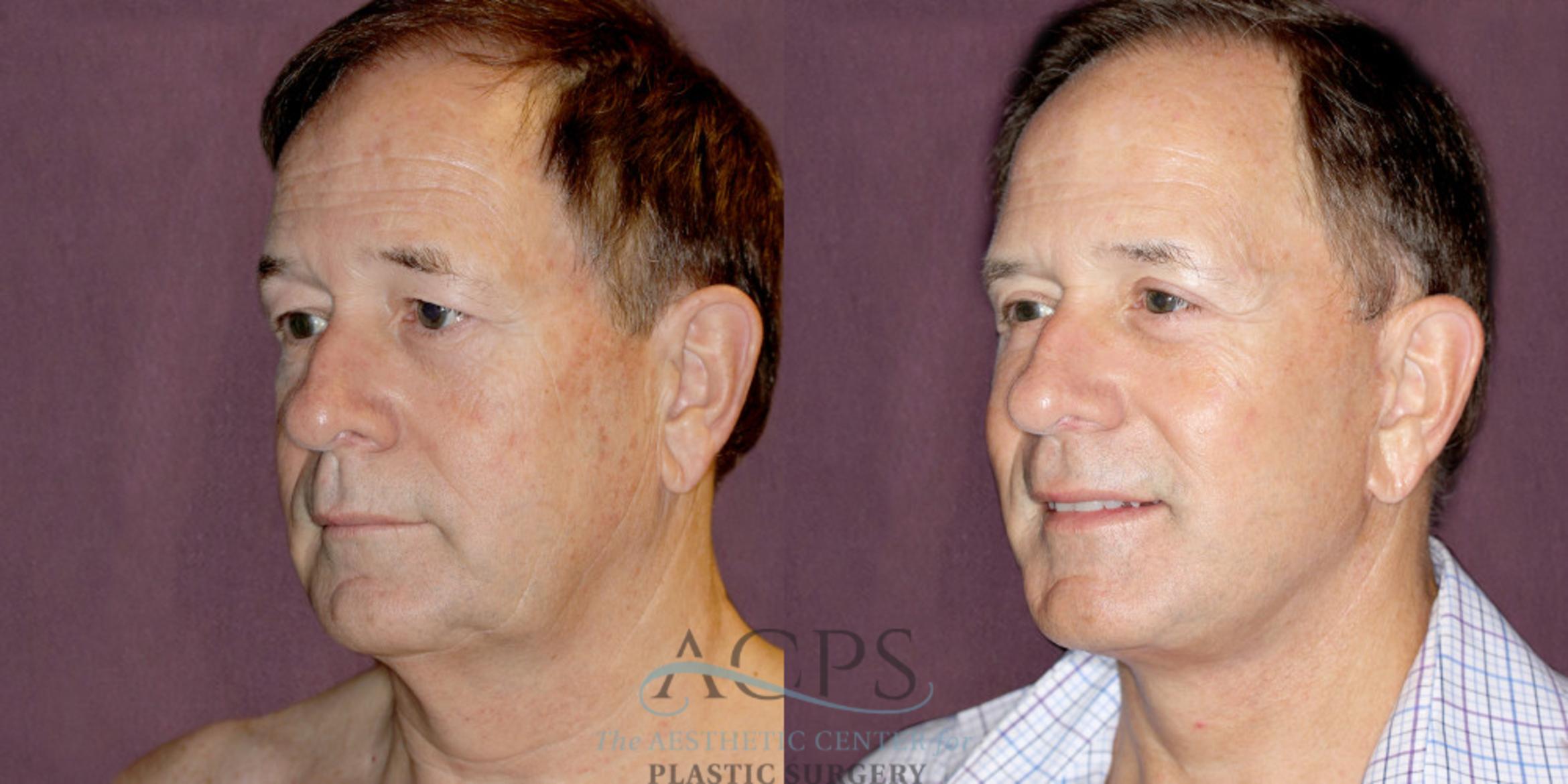 Before & After Neck Lift Case 1255 Oblique Left View: View in Houston, TX