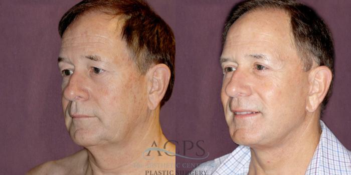 Before & After Neck Lift Case 1255 Oblique Left View: View in Houston, TX