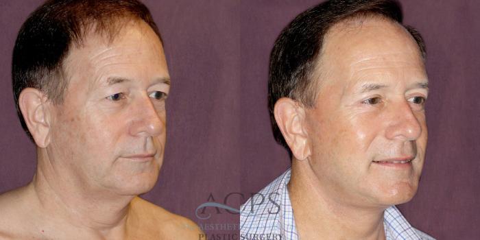 Before & After Neck Lift Case 1255 Oblique Right View: View in Houston, TX