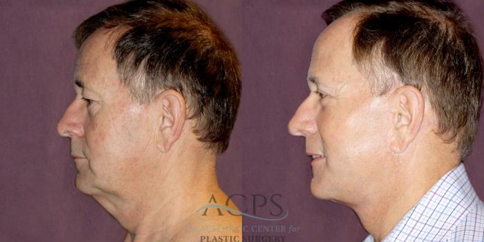 Before & After Neck Lift Case 1255 Side Left View: View in Houston, TX