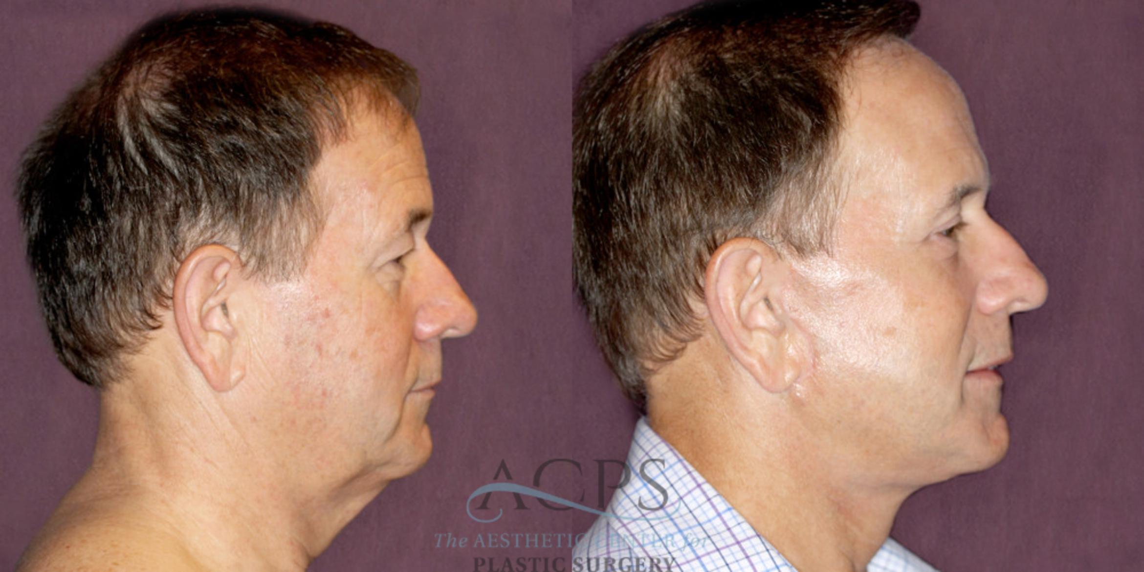 Before & After Neck Lift Case 1255 Side Right View: View in Houston, TX