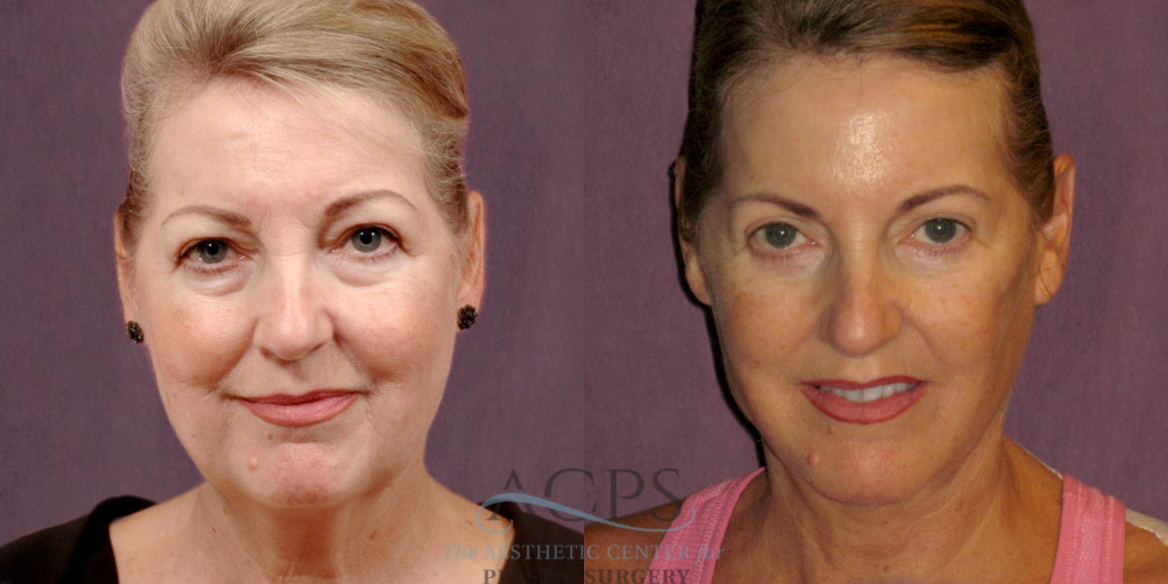 Before & After Neck Lift Case 1256 Front View: View in Houston, TX