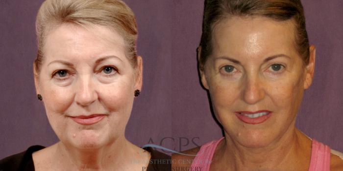 Before & After Neck Lift Case 1256 Front View: View in Houston, TX