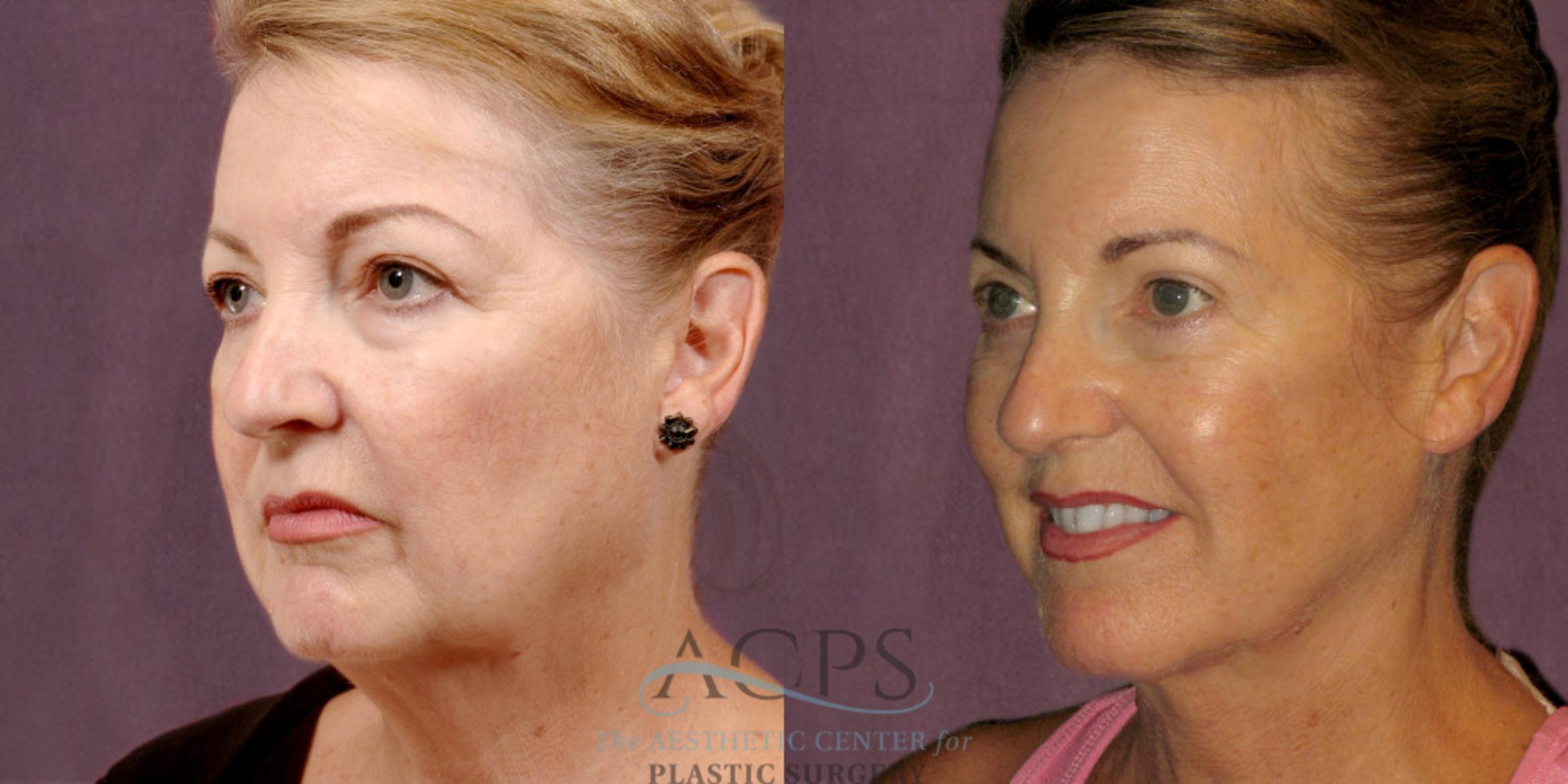 Before & After Neck Lift Case 1256 Oblique Left View: View in Houston, TX