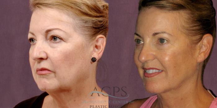 Before & After Neck Lift Case 1256 Oblique Left View: View in Houston, TX