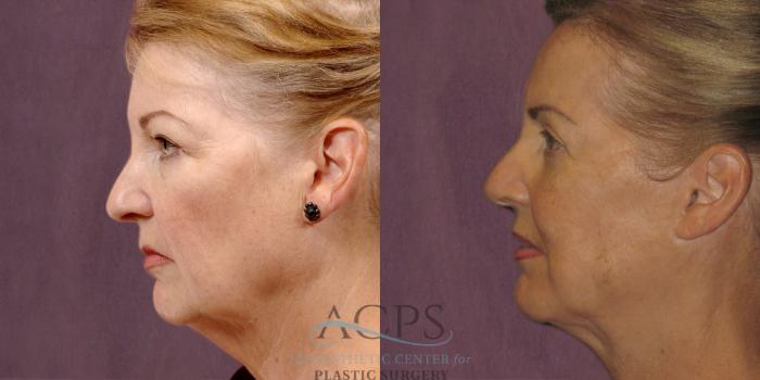 Before & After Neck Lift Case 1256 Side Left View: View in Houston, TX