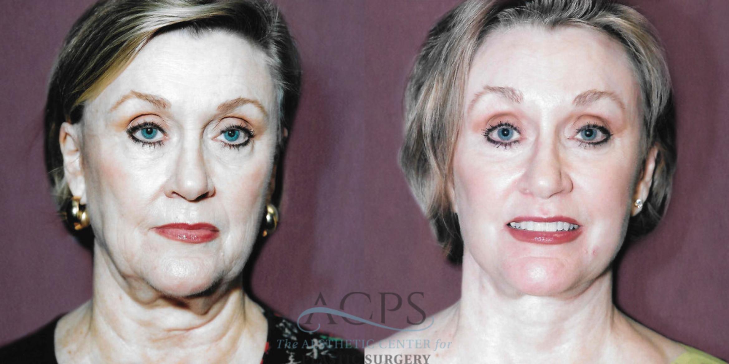 Before & After Facelift Case 1257 Front View: View in Houston, TX
