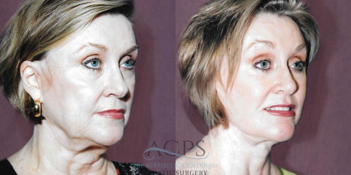 Before & After Facelift Case 1257 Oblique Right View: View in Houston, TX