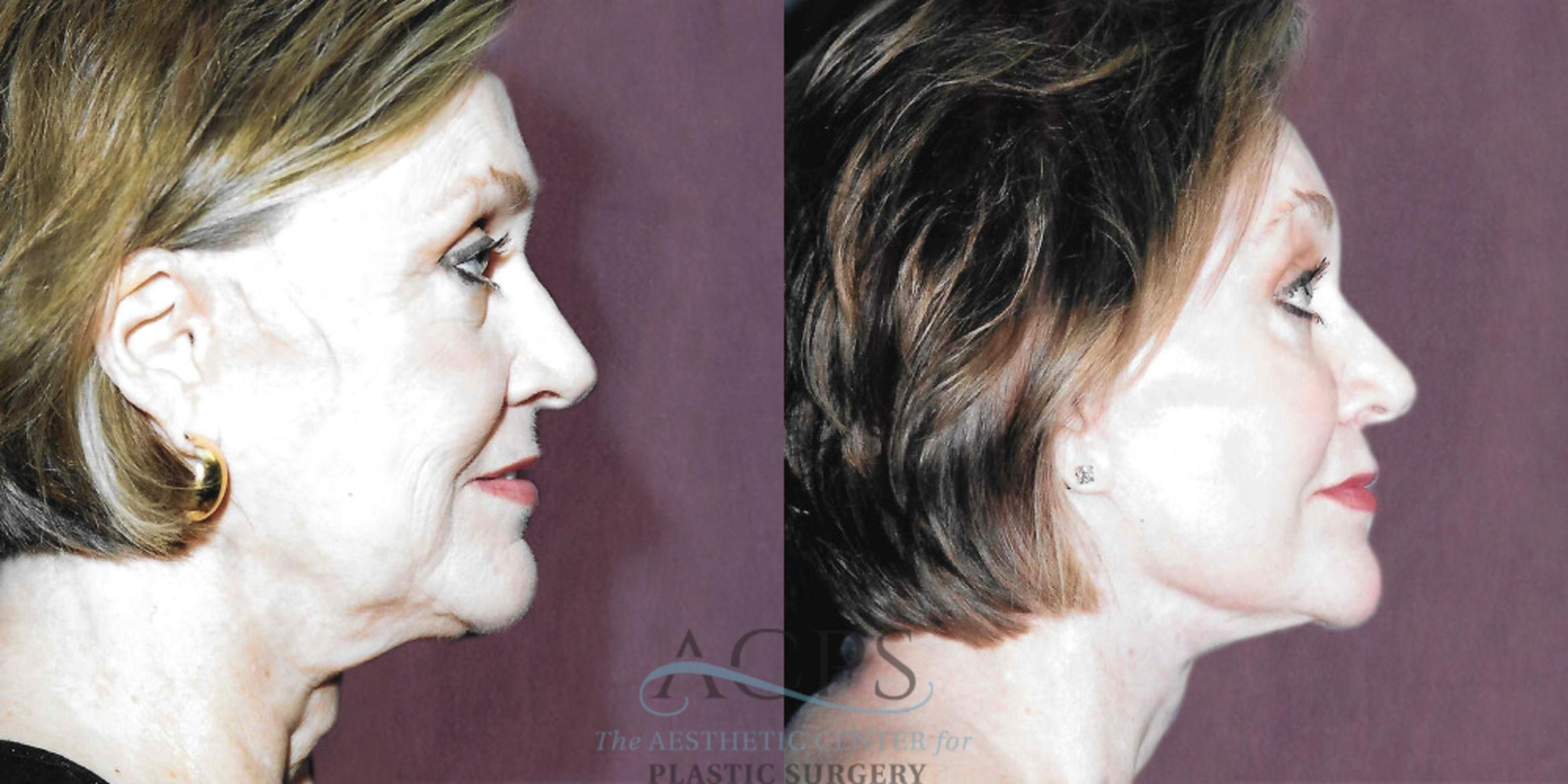 Before & After Facelift Case 1257 Side Right View: View in Houston, TX