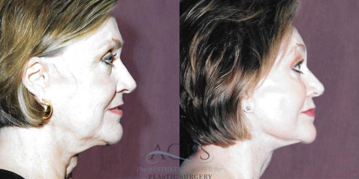 Before & After Facelift Case 1257 Side Right View: View in Houston, TX