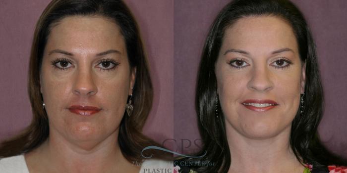 Before & After Neck Lift Case 1258 Front View: View in Houston, TX