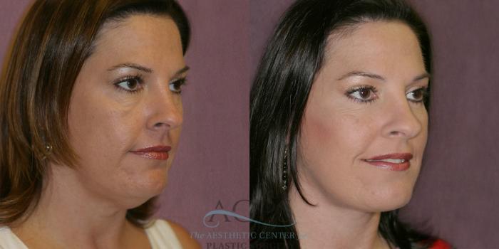 Before & After Eyelid Surgery Case 1258 Oblique Right View: View in Houston, TX
