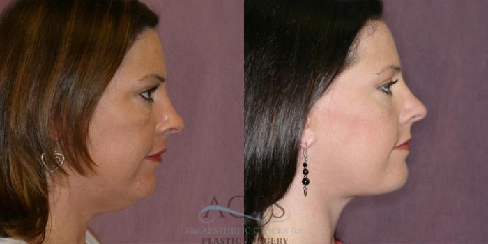Before & After Eyelid Surgery Case 1258 Side Right View: View in Houston, TX