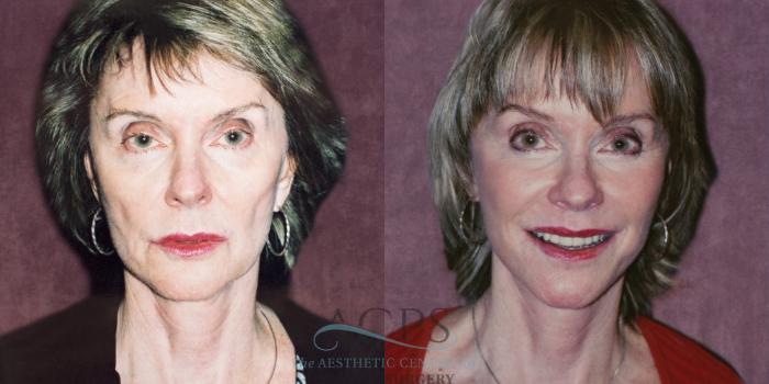 Before & After Facelift Case 1260 Front View: View in Houston, TX