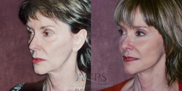 Before & After Facelift Case 1260 Oblique Left View: View in Houston, TX