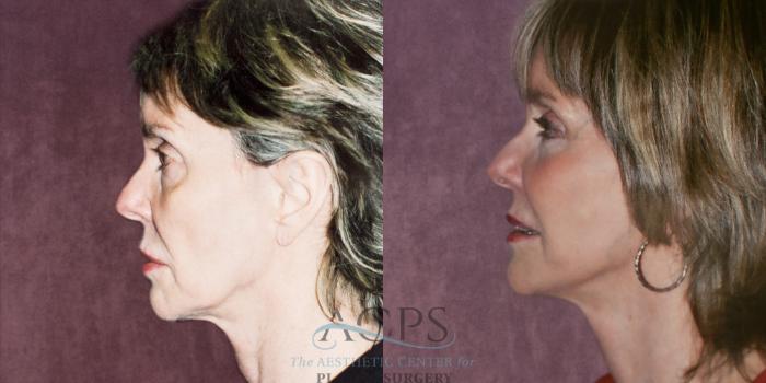 Before & After Facelift Case 1260 Side Left View: View in Houston, TX