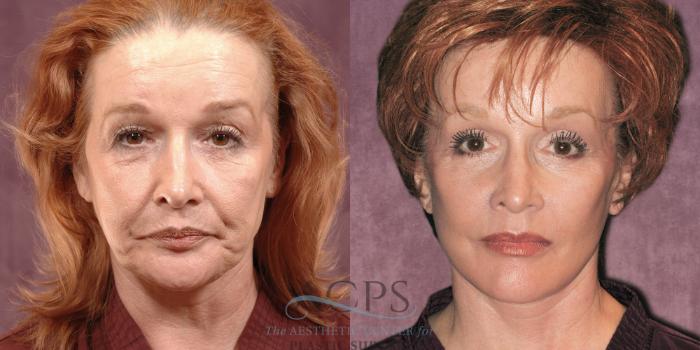 Before & After Facelift Case 1261 Front View: View in Houston, TX