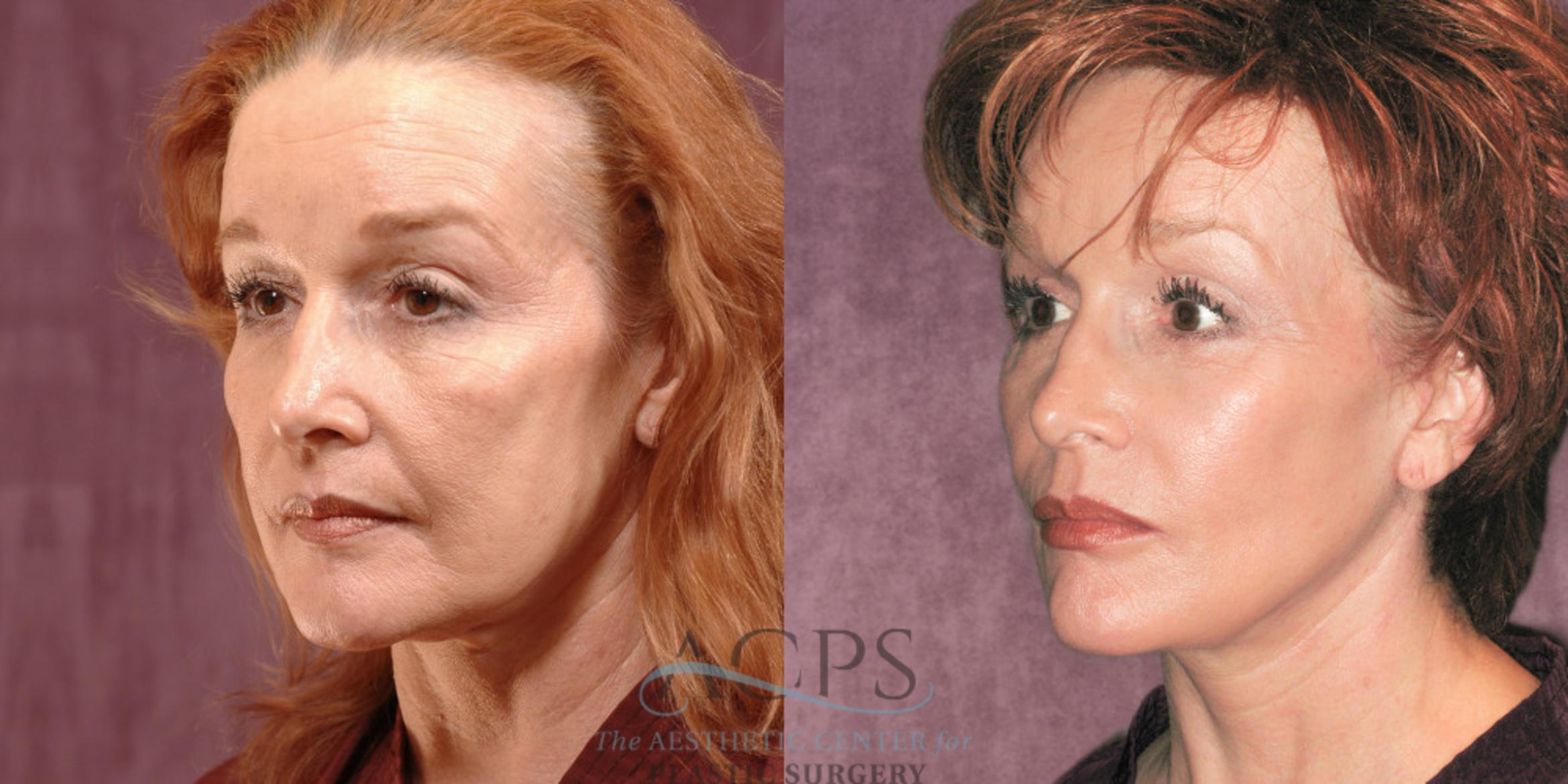 Before & After Facelift Case 1261 Oblique Left View: View in Houston, TX