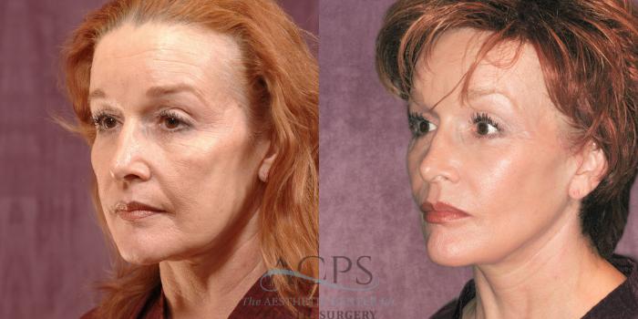 Before & After Facelift Case 1261 Oblique Left View: View in Houston, TX