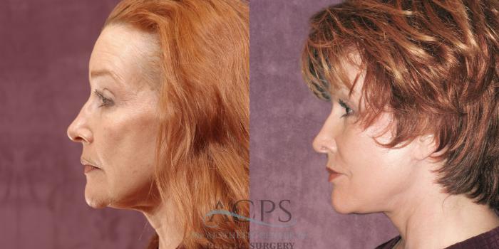 Before & After Facelift Case 1261 Side Left View: View in Houston, TX