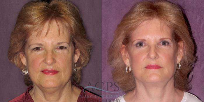 Before & After Neck Lift Case 1262 Front View: View in Houston, TX