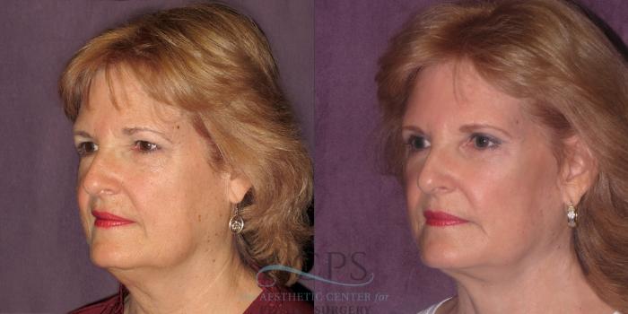 Before & After Facelift Case 1262 Oblique Left View: View in Houston, TX