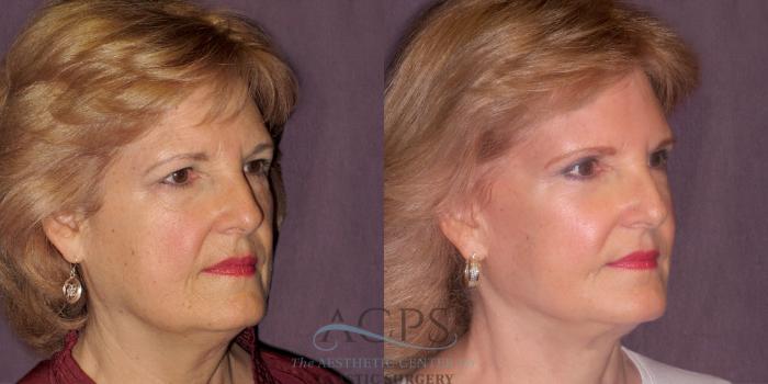 Before & After Facelift Case 1262 Oblique Right View: View in Houston, TX