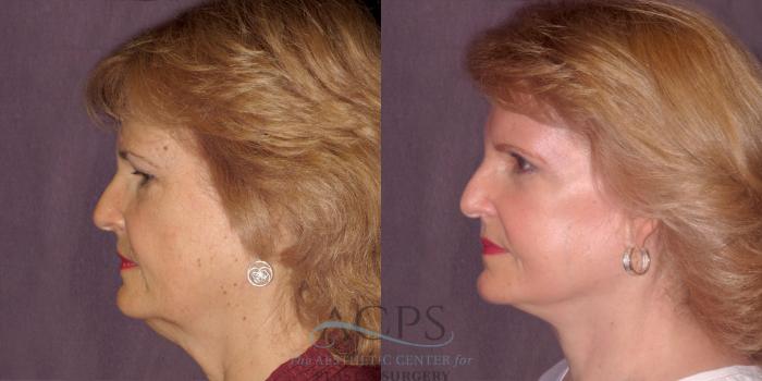 Before & After Facelift Case 1262 Side Left View: View in Houston, TX