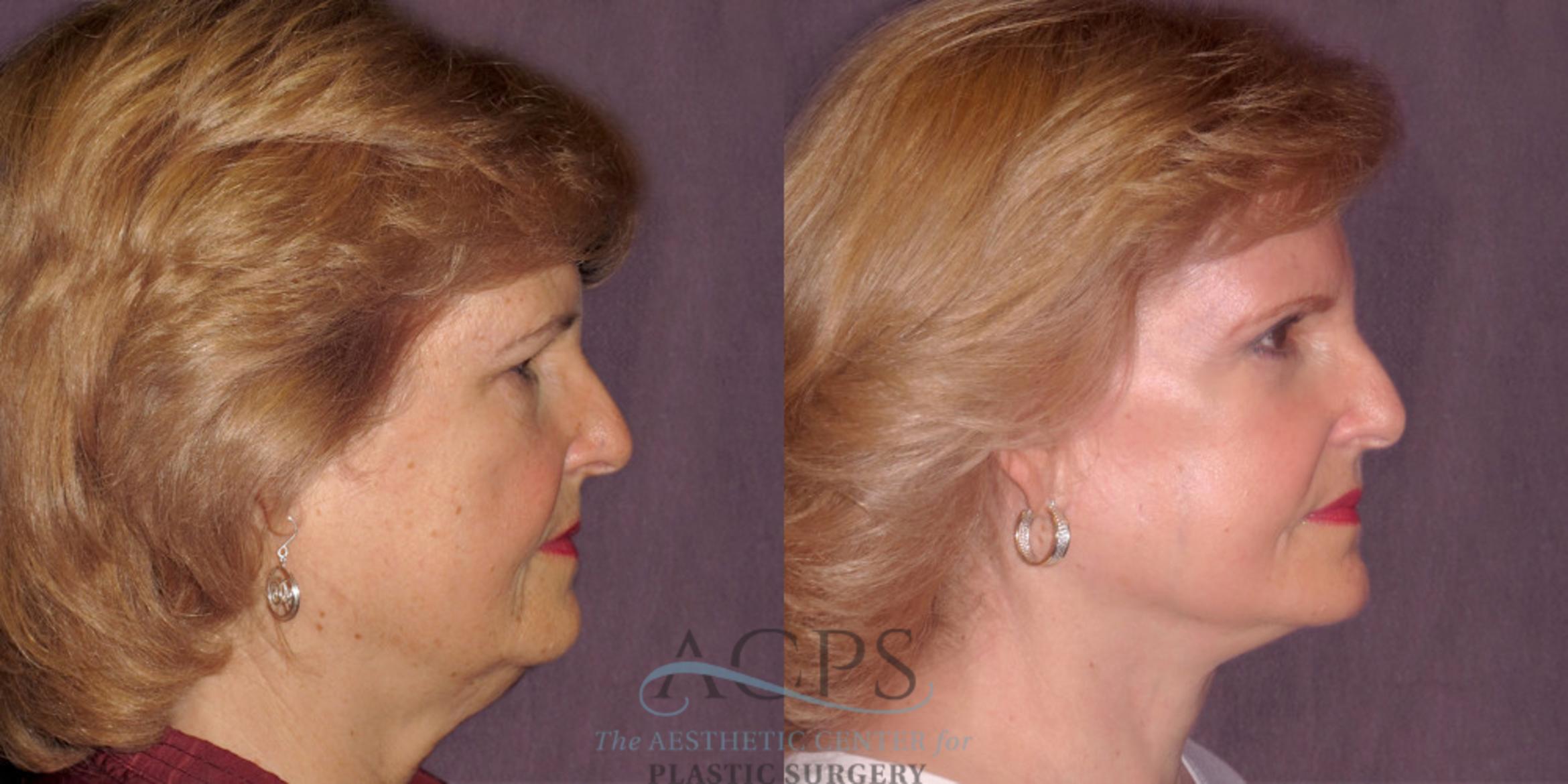 Before & After Facelift Case 1262 Side Right View: View in Houston, TX