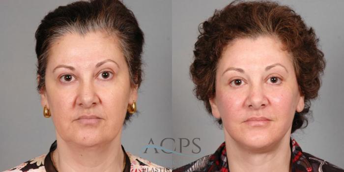 Before & After Facelift Case 1263 Front View: View in Houston, TX