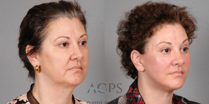 Before & After Facelift Case 1263 Oblique View: View in Houston, TX