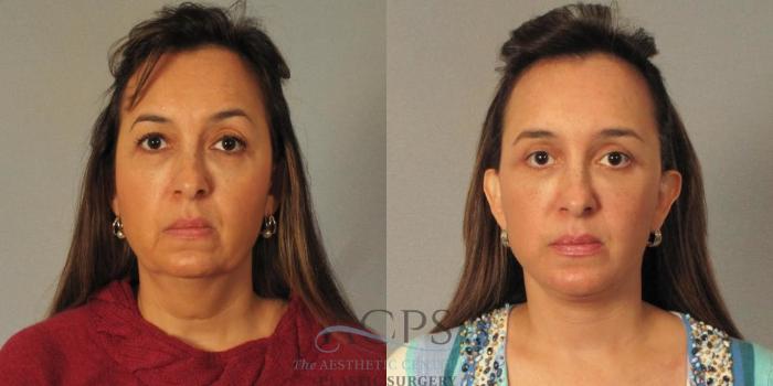 Before & After Facelift Case 1264 Front View: View in Houston, TX
