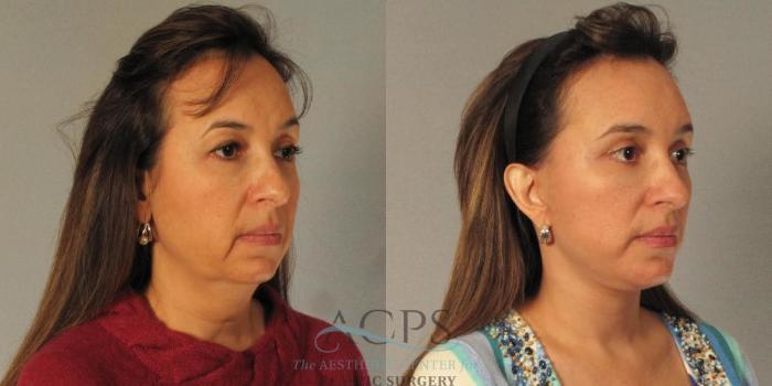 Before & After Facelift Case 1264 Oblique View: View in Houston, TX