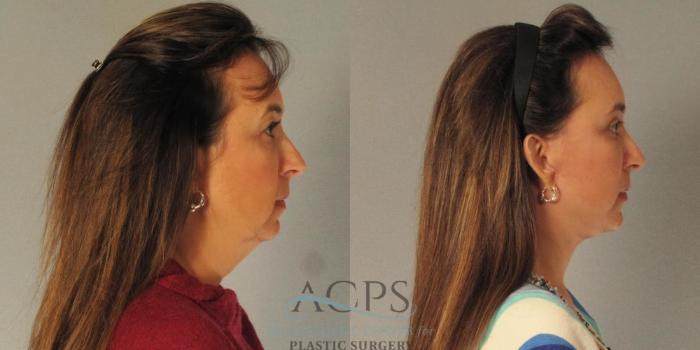Before & After Facelift Case 1264 Side View: View in Houston, TX