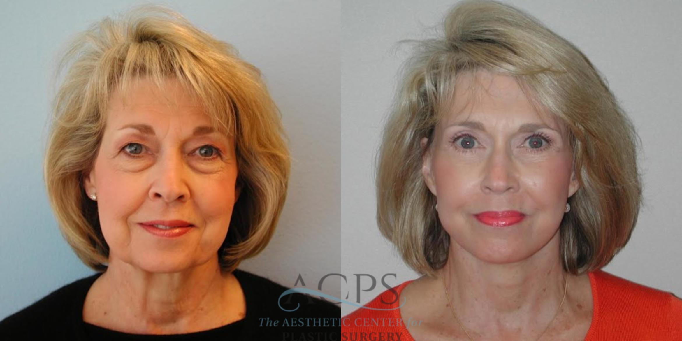 Before & After Facelift Case 1265 Front View: View in Houston, TX