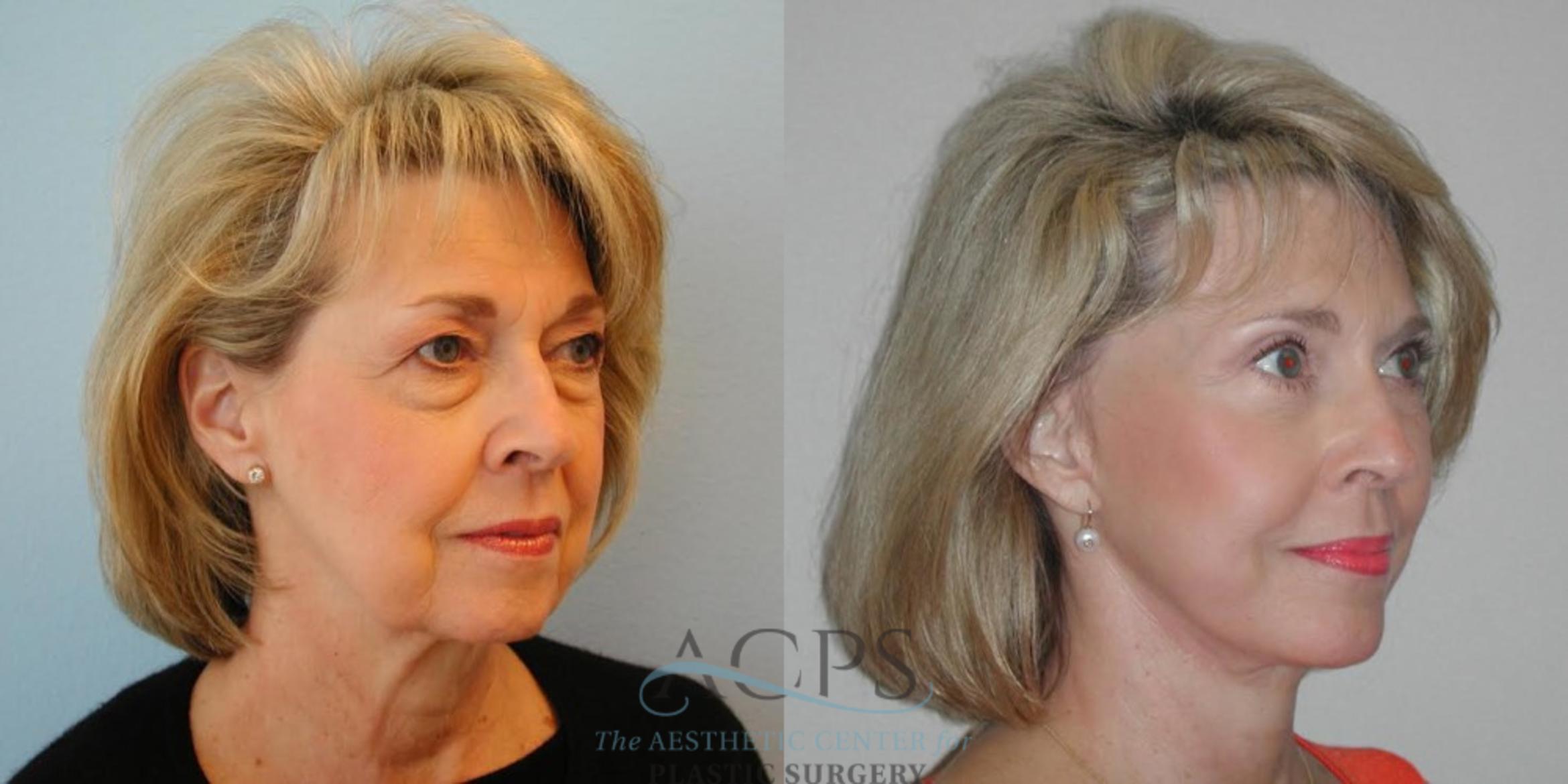 Before & After Facelift Case 1265 Oblique View: View in Houston, TX