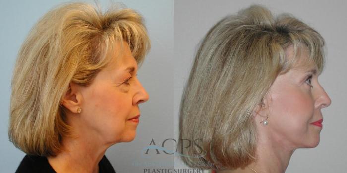 Before & After Facelift Case 1265 Side View: View in Houston, TX